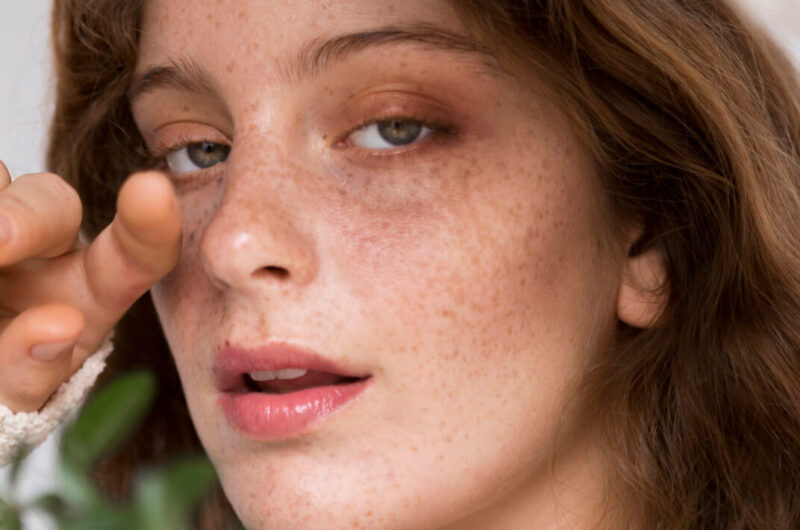 Acne treatment